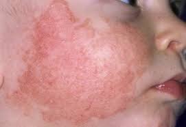 Chàm thể tạng - Hình ảnh minh họa